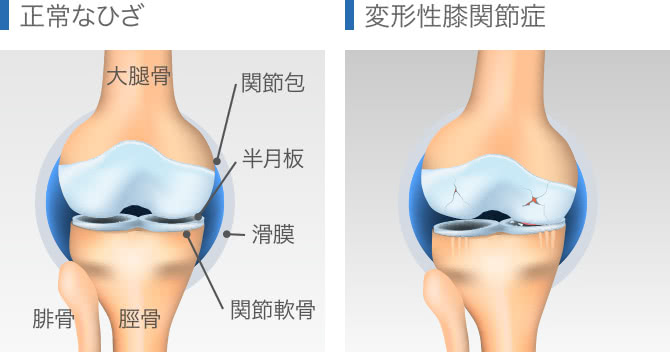 正常な膝と変形性膝関節症との比較