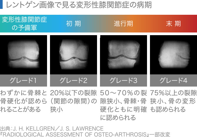 レントゲン画像による変形性膝関節症のグレード指標