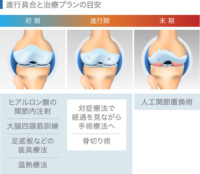 変形性膝関節症の進行と治療プラン