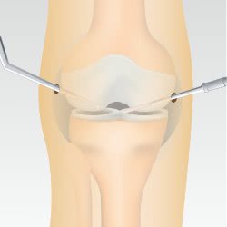 変形性膝関節症のクリーニング手術