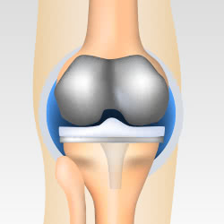変形性膝関節症の人工関節置換術