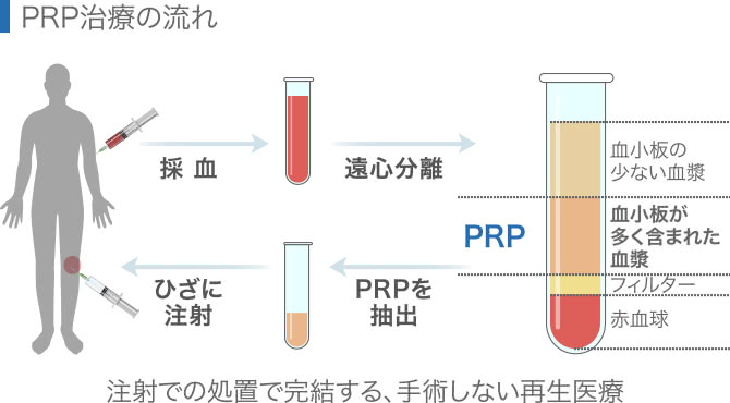 PRP治療の流れ