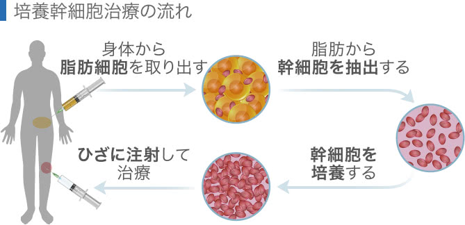 培養幹細胞治療の流れ