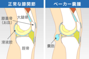 ベーカー嚢腫