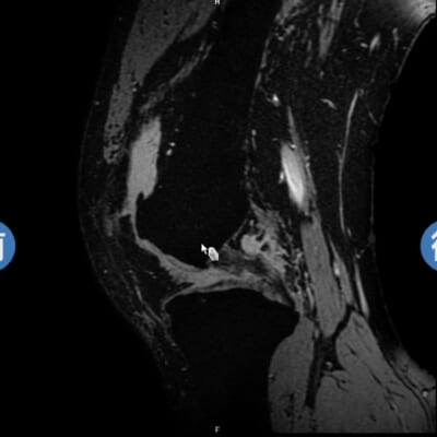膝MRI画像（50代／変形性膝関節症）