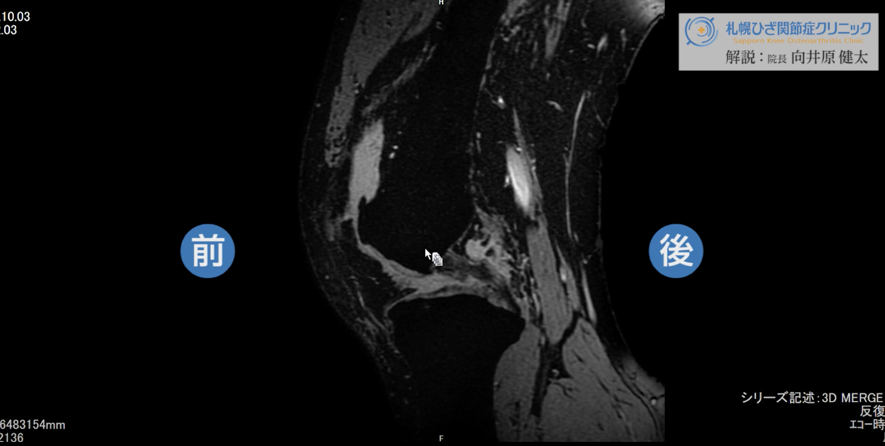 【膝MRI】50代後半｜変形性膝関節症の症例を解説します